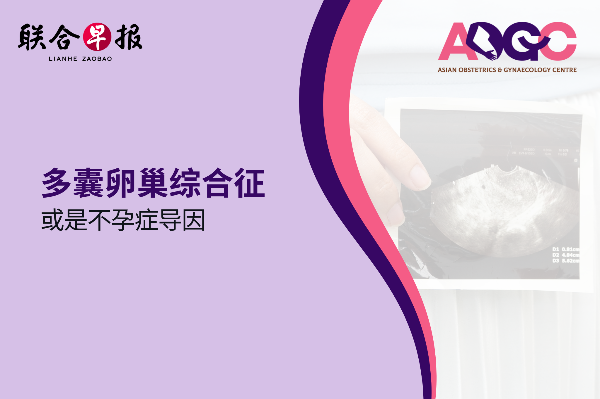 多囊卵巢综合征 或是不孕症导因