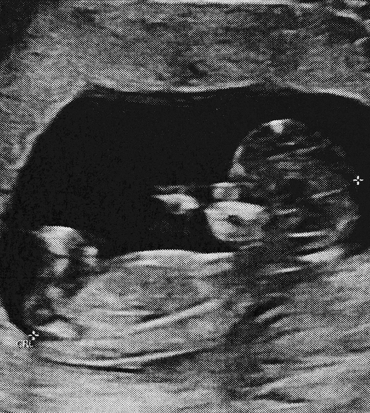 Amniocentesis (1) 1